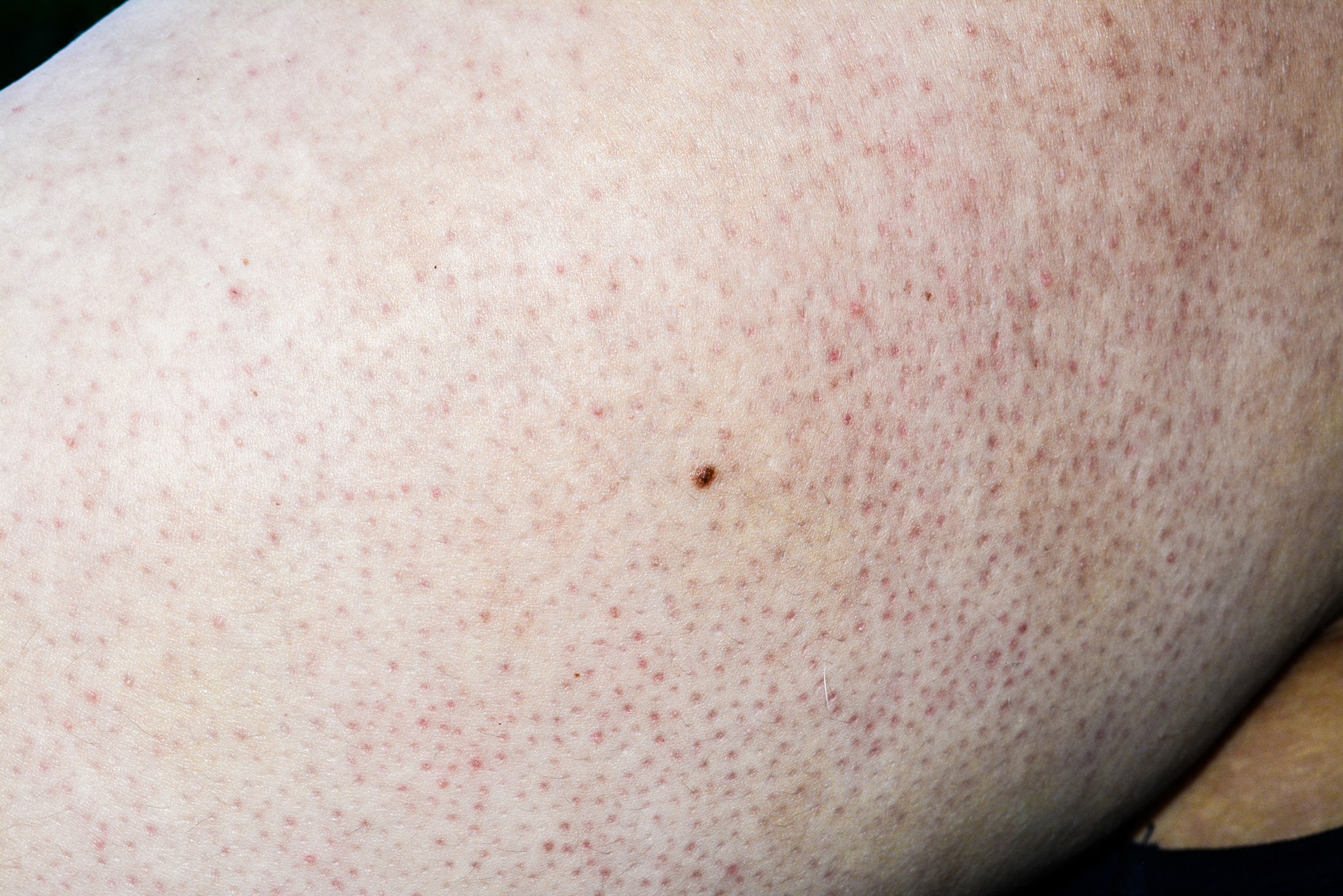 Keratosis Pilaris skin
