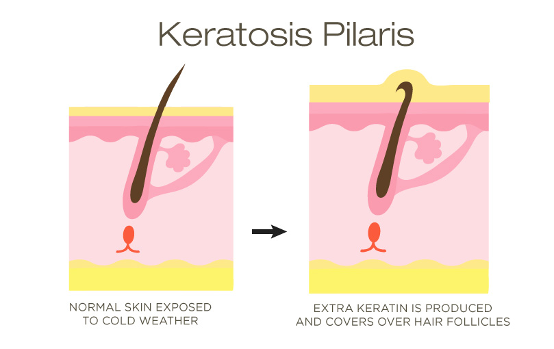 Keratosis Pilaris: Here's What You Need to Know 2 Keratosis Pilaris hair follicle