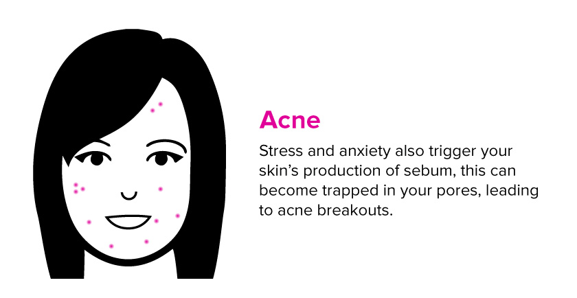 What Happens to Your Skin When You’re Stressed or Anxious? 4 acne and stress on the skin