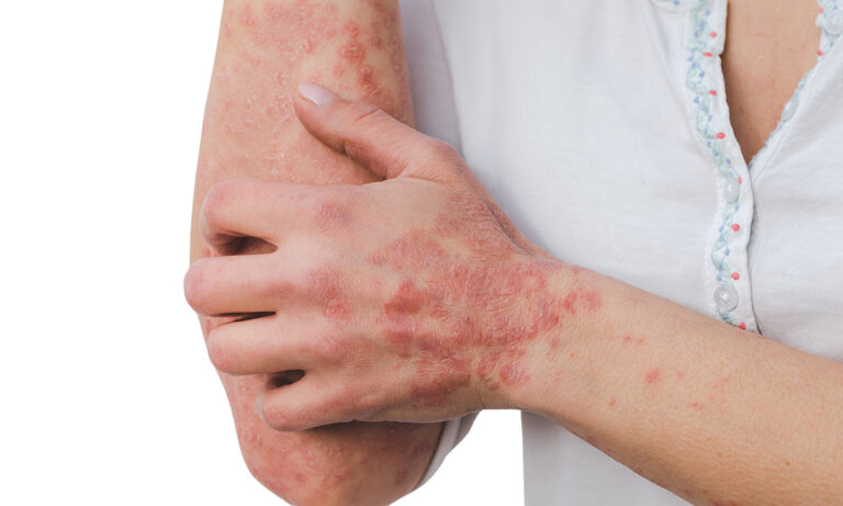 eczma