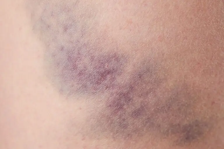 skin bruising
